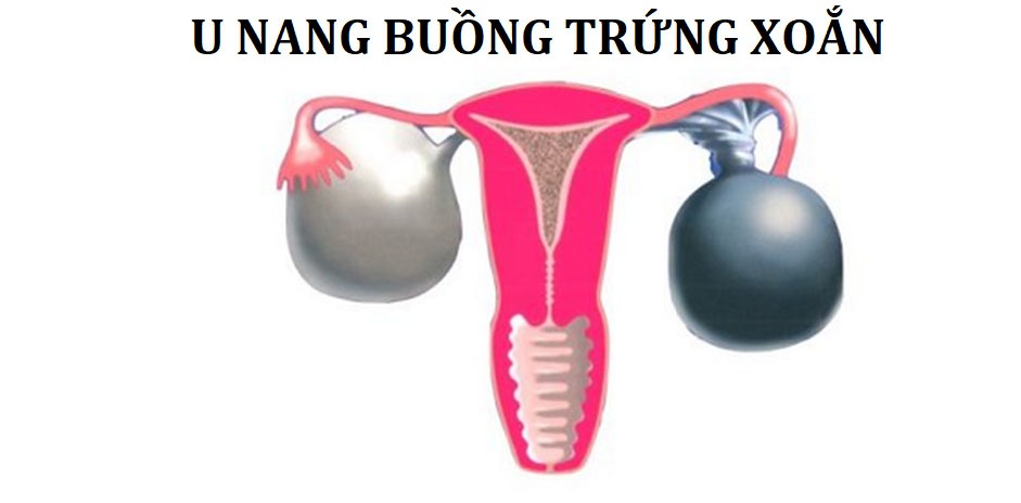 U-nang-buong-trung-xoan-co-the-de-doa-tinh-mang-chi-em.webp